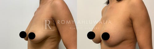 Before & After Result of Breast Augmentation Patient #17