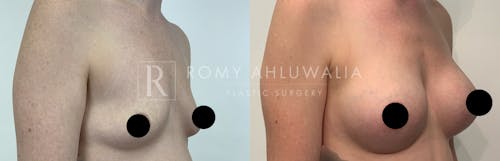 Before & After Result of Breast Augmentation Patient #16