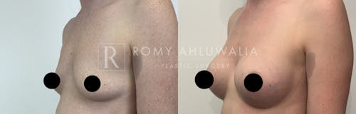 Before & After Result of Breast Augmentation Patient #16