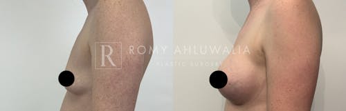Before & After Result of Breast Augmentation Patient #16