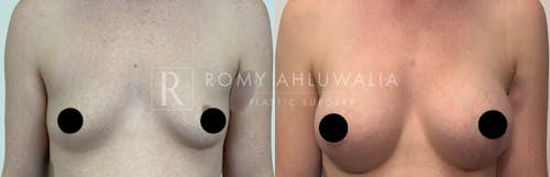 Before & After Result of Breast Augmentation Patient #16