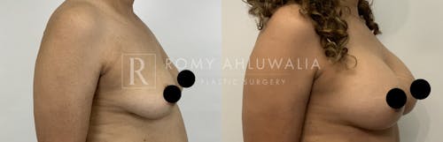 Before & After Result of Breast Augmentation Patient #15