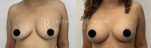 Before & After Result of Breast Augmentation Patient #15