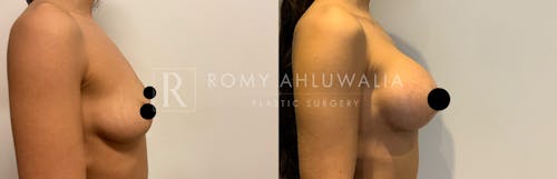 Before & After Result of Breast Augmentation Patient #2