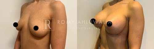 Before & After Result of Breast Augmentation Patient #2