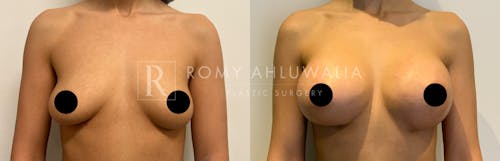 Before & After Result of Breast Augmentation Patient #2