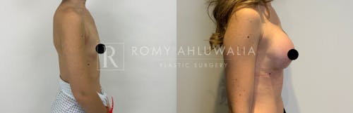 Before & After Result of Breast Augmentation Patient #3