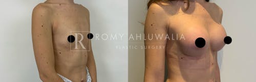 Before & After Result of Breast Augmentation Patient #3
