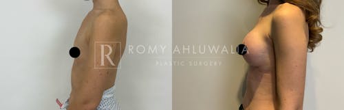 Before & After Result of Breast Augmentation Patient #3