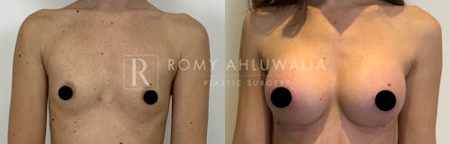 Before & After Result of Breast Augmentation Patient #3