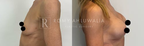 Before & After Result of Breast Augmentation Patient #1