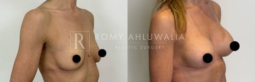 Before & After Result of Breast Augmentation Patient #1