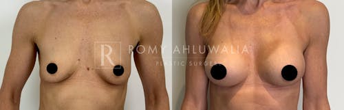 Before & After Result of Breast Augmentation Patient #1