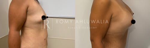 Before & After Result of Breast Augmentation Patient #13