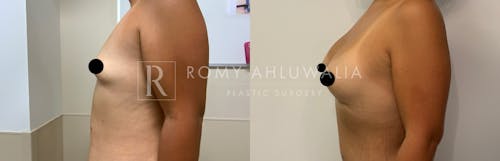 Before & After Result of Breast Augmentation Patient #13