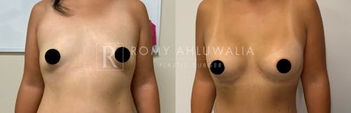 Before & After Result of Breast Augmentation Patient #13