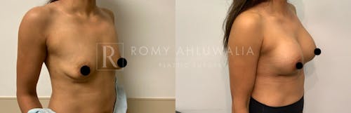 Before & After Result of Breast Augmentation Patient #12