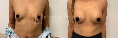 Before & After Result of Breast Augmentation Patient #12