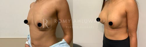 Before & After Result of Breast Augmentation Patient #12