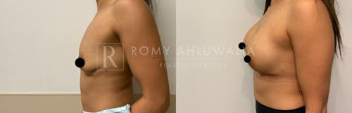 Before & After Result of Breast Augmentation Patient #12