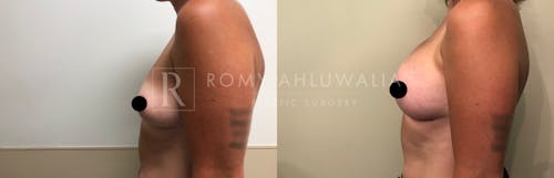 Before & After Result of Breast Augmentation Patient #4