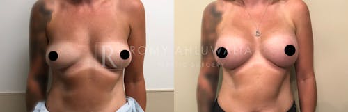 Before & After Result of Breast Augmentation Patient #4