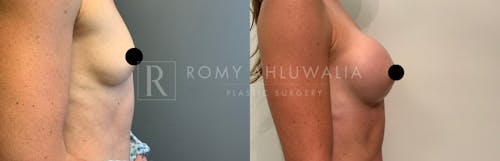 Before & After Result of Breast Augmentation Patient #11
