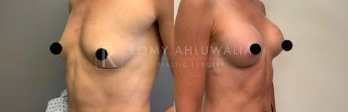 Before & After Result of Breast Augmentation Patient #11