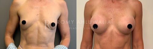 Before & After Result of Breast Augmentation Patient #11
