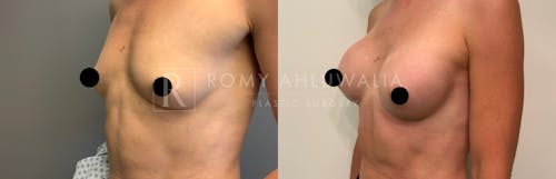 Before & After Result of Breast Augmentation Patient #11