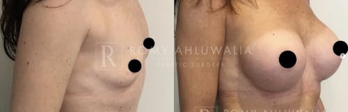 Before & After Result of Breast Augmentation Patient #10