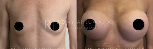Before & After Result of Breast Augmentation Patient #10