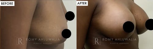Before & After Result of Breast Augmentation Patient #9