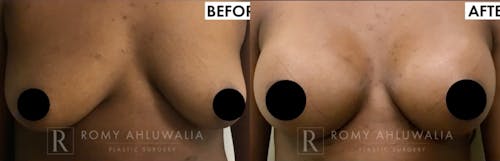 Before & After Result of Breast Augmentation Patient #9