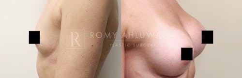 Before & After Result of Breast Augmentation Patient #8