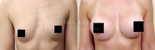 Before & After Result of Breast Augmentation Patient #8
