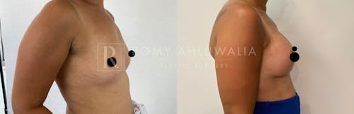 Before & After Result of Breast Augmentation Patient #7
