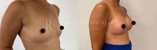 Before & After Result of Breast Augmentation Patient #7