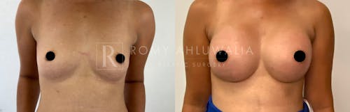 Before & After Result of Breast Augmentation Patient #7