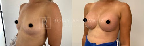 Before & After Result of Breast Augmentation Patient #7