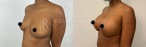 Before & After Result of Breast Augmentation Patient #6