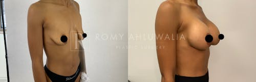 Before & After Result of Breast Augmentation Patient #5