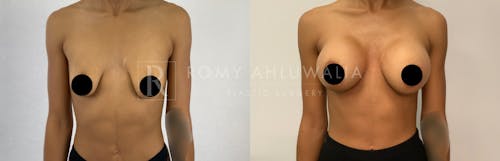 Before & After Result of Breast Augmentation Patient #5