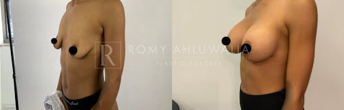 Before & After Result of Breast Augmentation Patient #5