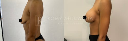 Before & After Result of Breast Augmentation Patient #5