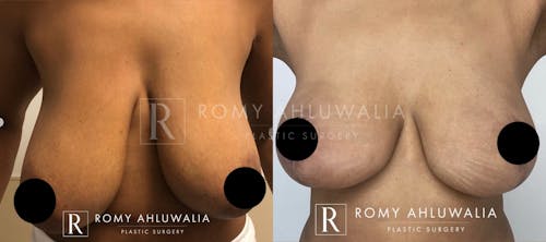 Before & After Result of Breast Reduction Patient #1