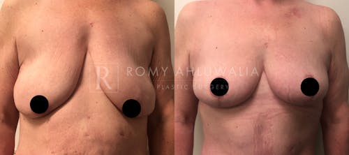 Before & After Result of Breast Reduction Patient #5
