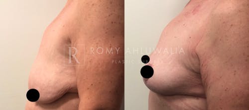 Before & After Result of Breast Reduction Patient #5