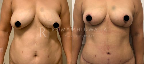 Before & After Result of Breast Reduction Patient #9