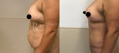 Before & After Result of Breast Reduction Patient #9